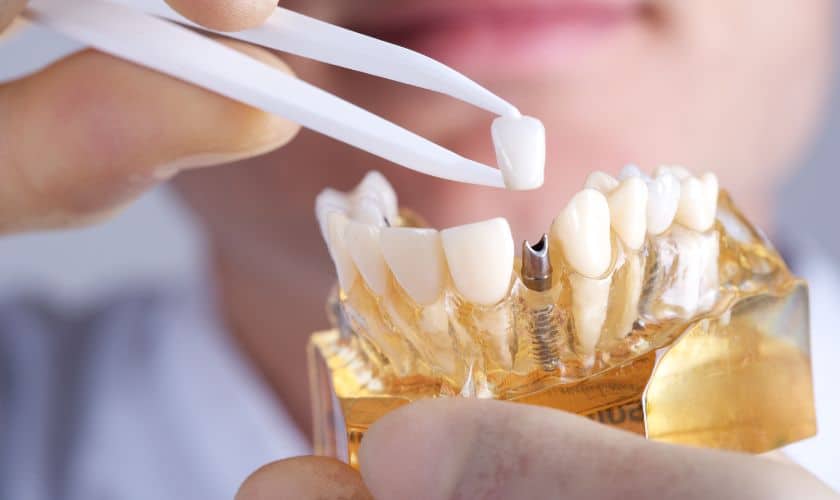 implant dentistry in Houston