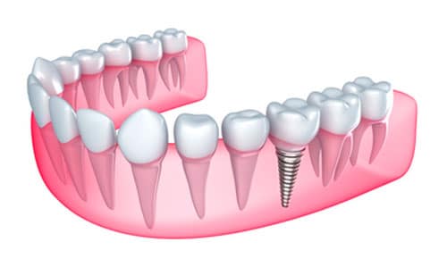 Dental Implants Surgery in Houston