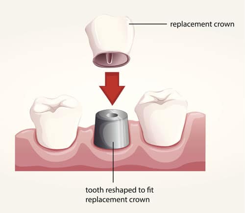 What Does Bone Graft Have To Do With Dental Implants Treatment