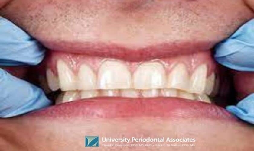 Gum Disease Treatment Houston