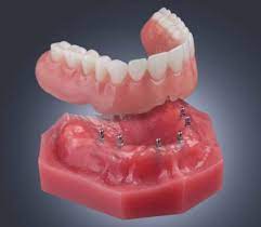 implant supported denture with more stability.