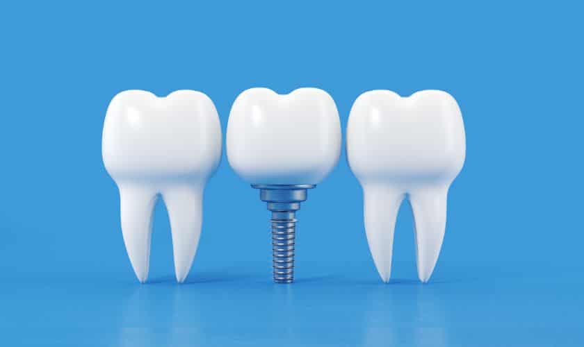 dental implant prevent gum disease