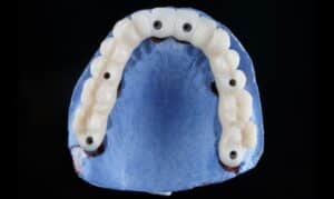 All on 6 Dental implant arch