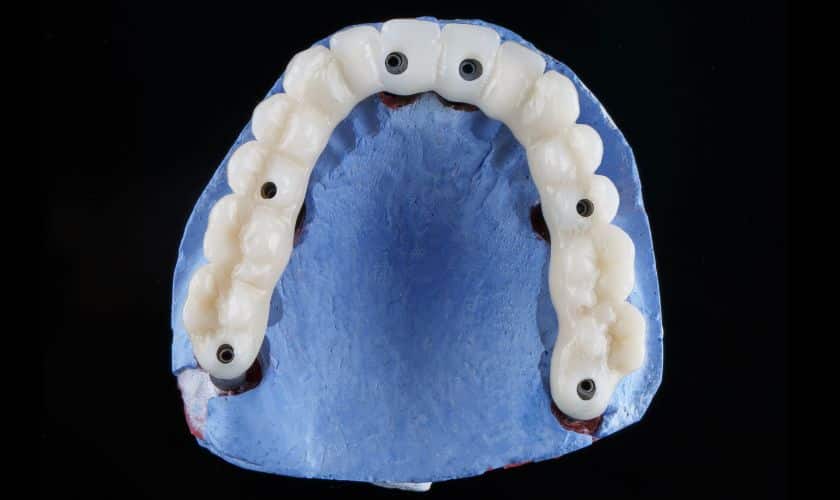 All on 6 Dental implant arch