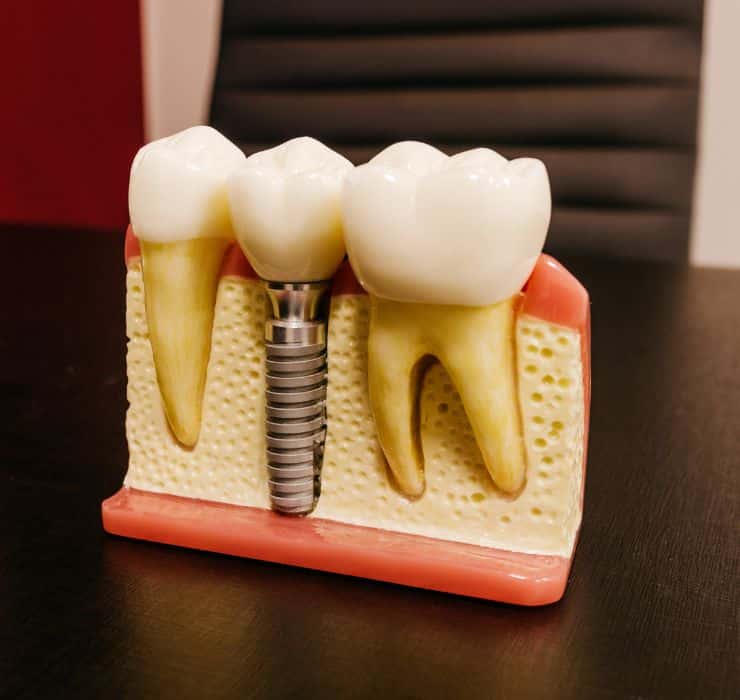 Dr. David Dennison, an Implant Dentist in Houston offering top notch dental implants treatment in Houston, TX