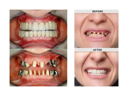Dental implant restoration for lost tooth