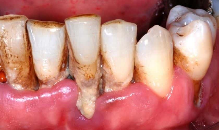 periodontal disease in Houston