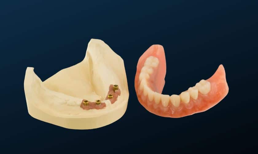 Implant supported dentures advantages