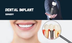 Featured image showing how to plan dental implant surgery