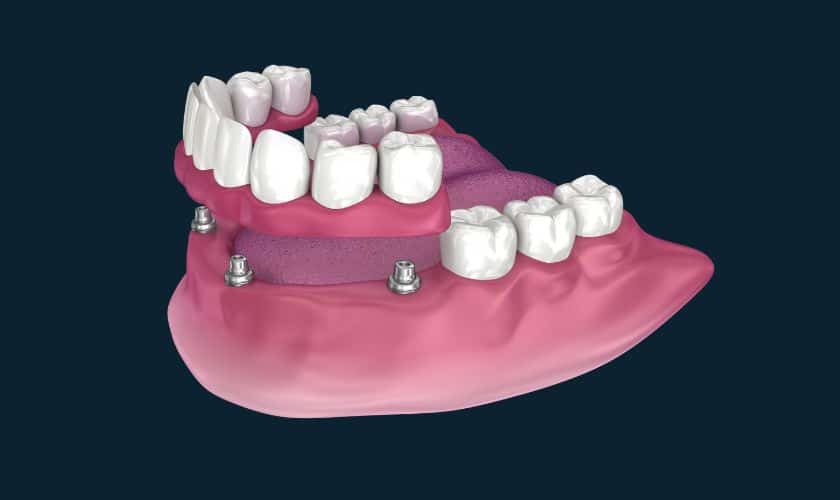 candidates for All on 4 implants