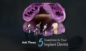 dental implants consultation in Houston tx
