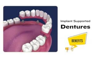 benefits of implant dentures