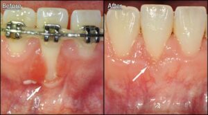 Braces causing gum receding