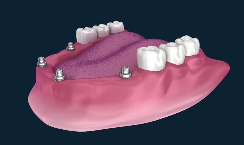 Graphic to illustrate All on 4 implant