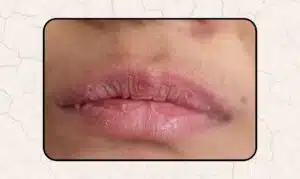 Dry lips and dry mouth