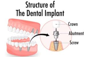 Diagram of structure process of Dental Implants