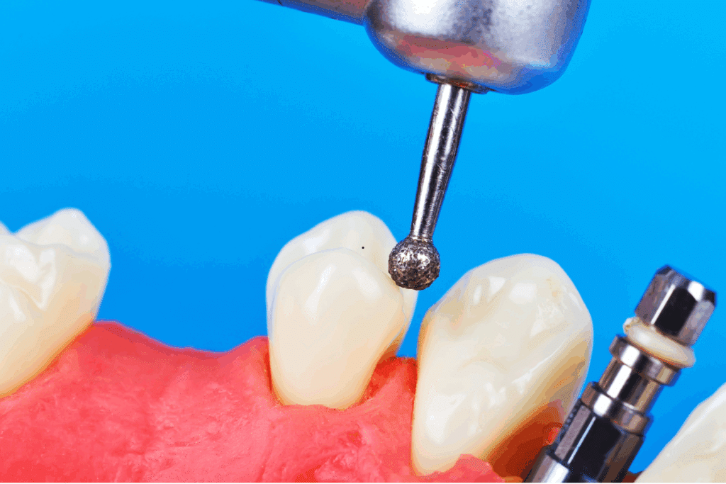 all on 4 vs all on 6 comparison by University Periodontal Associates Houston TX